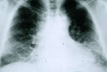 根据计算预测科学家们证明癌症药物可以对抗肺纤维化