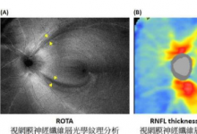 可视化视网膜轴突纤维束的新技术用于早期诊断视神经病变